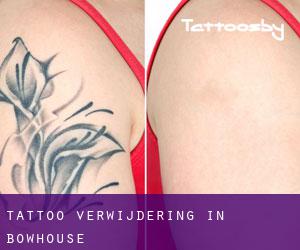 Tattoo verwijdering in Bowhouse