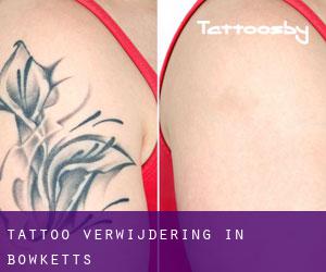 Tattoo verwijdering in Bowketts