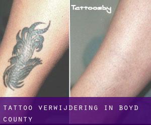 Tattoo verwijdering in Boyd County