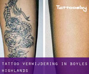 Tattoo verwijdering in Boyles Highlands