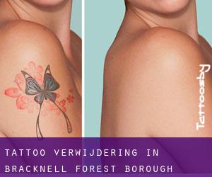 Tattoo verwijdering in Bracknell Forest (Borough)