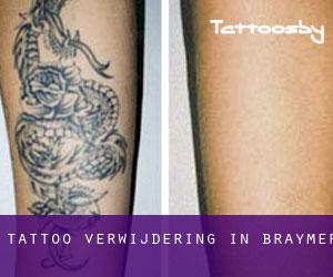 Tattoo verwijdering in Braymer