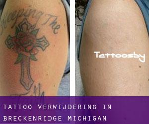 Tattoo verwijdering in Breckenridge (Michigan)