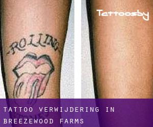 Tattoo verwijdering in Breezewood Farms