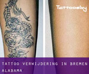 Tattoo verwijdering in Bremen (Alabama)