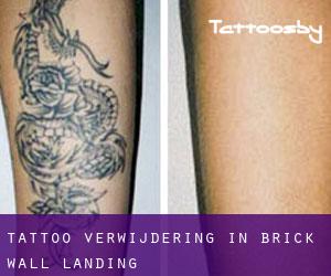 Tattoo verwijdering in Brick Wall Landing