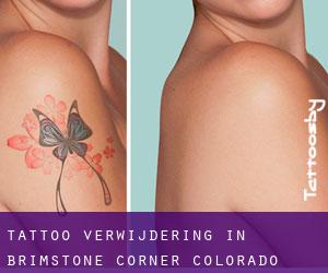 Tattoo verwijdering in Brimstone Corner (Colorado)