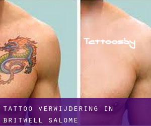 Tattoo verwijdering in Britwell Salome