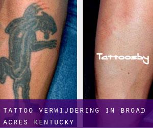 Tattoo verwijdering in Broad Acres (Kentucky)