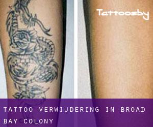 Tattoo verwijdering in Broad Bay Colony
