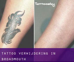 Tattoo verwijdering in Broadmouth