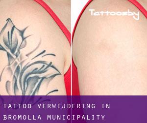 Tattoo verwijdering in Bromölla Municipality