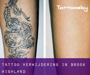 Tattoo verwijdering in Brook Highland