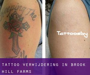 Tattoo verwijdering in Brook Hill Farms