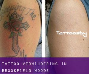Tattoo verwijdering in Brookfield Woods