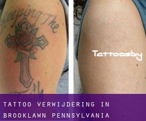 Tattoo verwijdering in Brooklawn (Pennsylvania)
