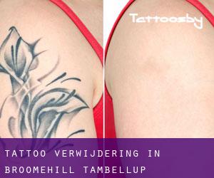 Tattoo verwijdering in Broomehill-Tambellup