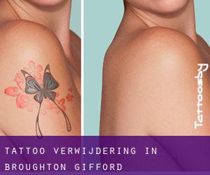 Tattoo verwijdering in Broughton Gifford