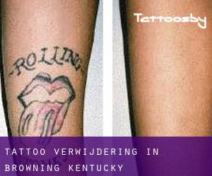Tattoo verwijdering in Browning (Kentucky)