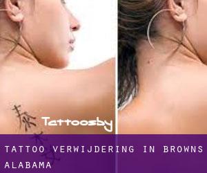 Tattoo verwijdering in Browns (Alabama)