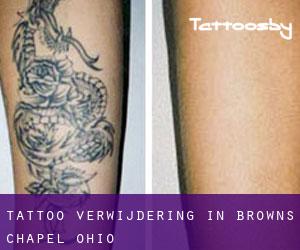 Tattoo verwijdering in Browns Chapel (Ohio)