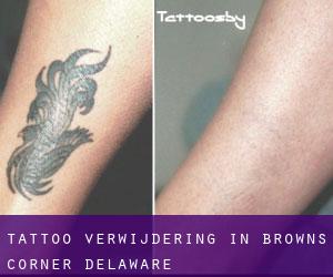 Tattoo verwijdering in Browns Corner (Delaware)