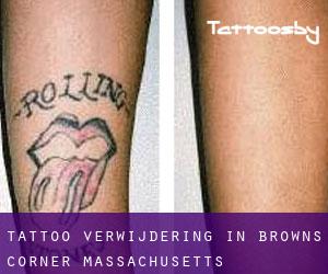 Tattoo verwijdering in Browns Corner (Massachusetts)