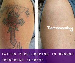 Tattoo verwijdering in Browns Crossroad (Alabama)