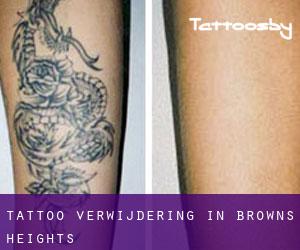 Tattoo verwijdering in Browns Heights