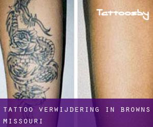 Tattoo verwijdering in Browns (Missouri)