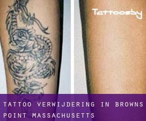 Tattoo verwijdering in Browns Point (Massachusetts)
