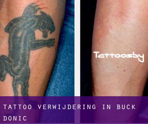 Tattoo verwijdering in Buck Donic