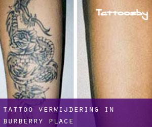 Tattoo verwijdering in Burberry Place