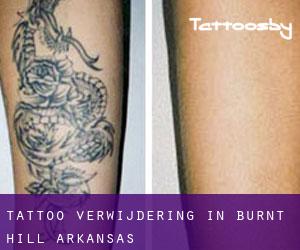 Tattoo verwijdering in Burnt Hill (Arkansas)