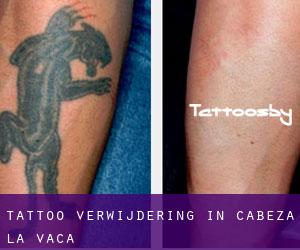 Tattoo verwijdering in Cabeza la Vaca