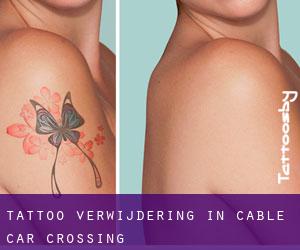 Tattoo verwijdering in Cable Car Crossing