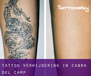 Tattoo verwijdering in Cabra del Camp