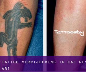 Tattoo verwijdering in Cal-Nev-Ari