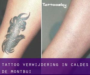 Tattoo verwijdering in Caldes de Montbui