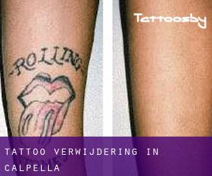 Tattoo verwijdering in Calpella