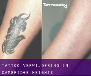 Tattoo verwijdering in Cambridge Heights