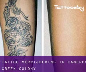 Tattoo verwijdering in Cameron Creek Colony