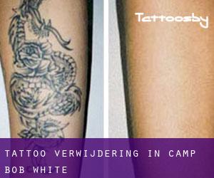 Tattoo verwijdering in Camp Bob White
