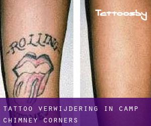Tattoo verwijdering in Camp Chimney Corners