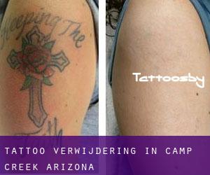 Tattoo verwijdering in Camp Creek (Arizona)