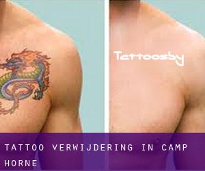 Tattoo verwijdering in Camp Horne