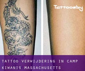 Tattoo verwijdering in Camp Kiwanis (Massachusetts)