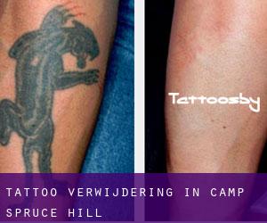 Tattoo verwijdering in Camp Spruce Hill