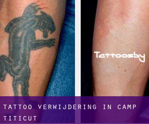 Tattoo verwijdering in Camp Titicut