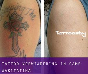 Tattoo verwijdering in Camp Wakitatina